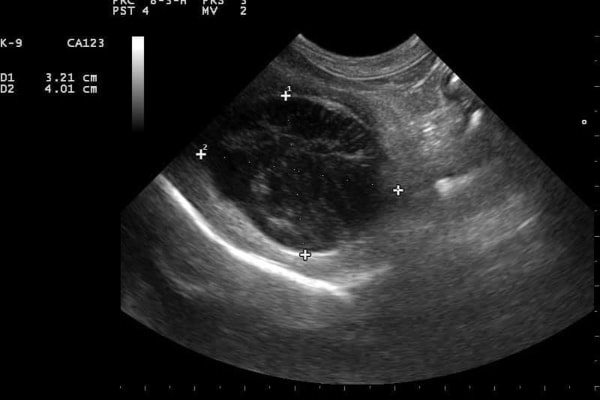 سونوگرافی کیسه صفرا
